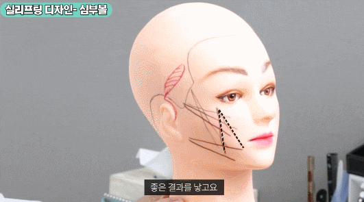 If You Decide Based Only on Before-and-After Photos for Gangnam Mini Facelift, You’ll End Up Regretting It image 2