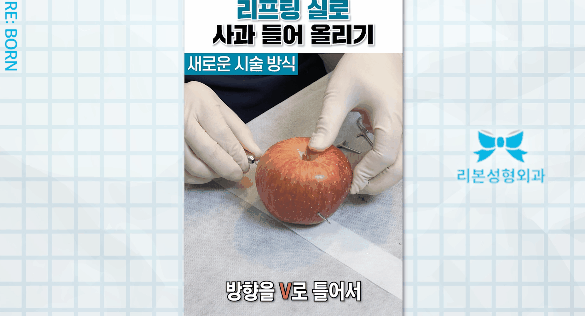 마리오네트 리프팅 가격, 비용 관련해서 궁금하다면 관련 이미지 4