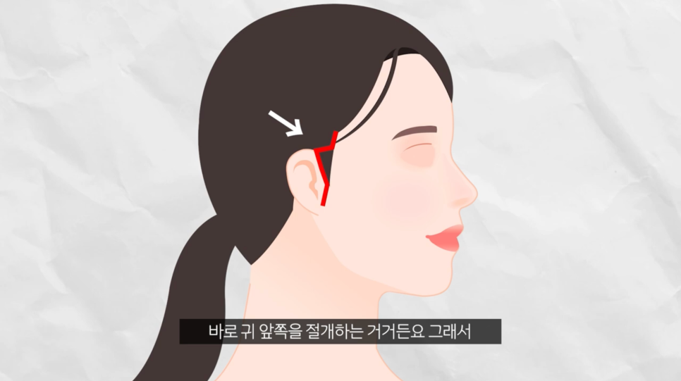 압구정 리프팅 성형외과 미니거상 찐 후기를 원한다면 관련 이미지 4