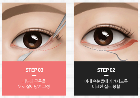 Why Searching for Before-and-After Photos of Upper and Lower Blepharoplasty Is Pointless image 5