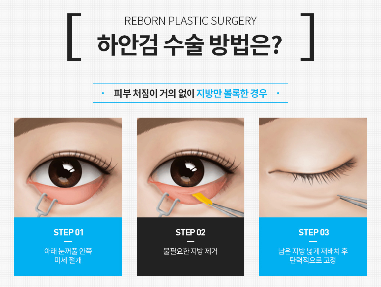 Gangnam Under-Eye Fat Repositioning: How Is It Different from Lower Blepharoplasty, and Which Method Is Right for My Eyes? image 3