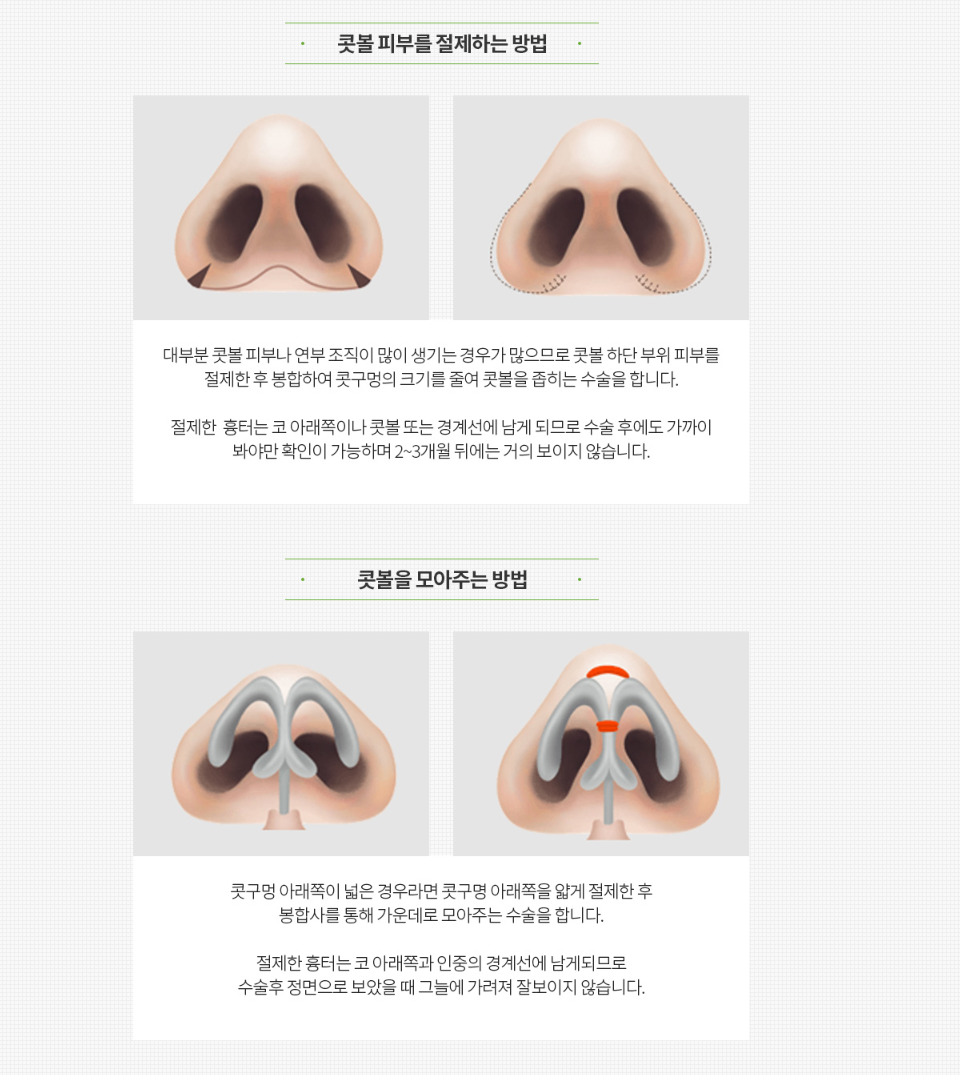 강남코성형외과 콧볼축소술로 변화하기 관련 이미지 4