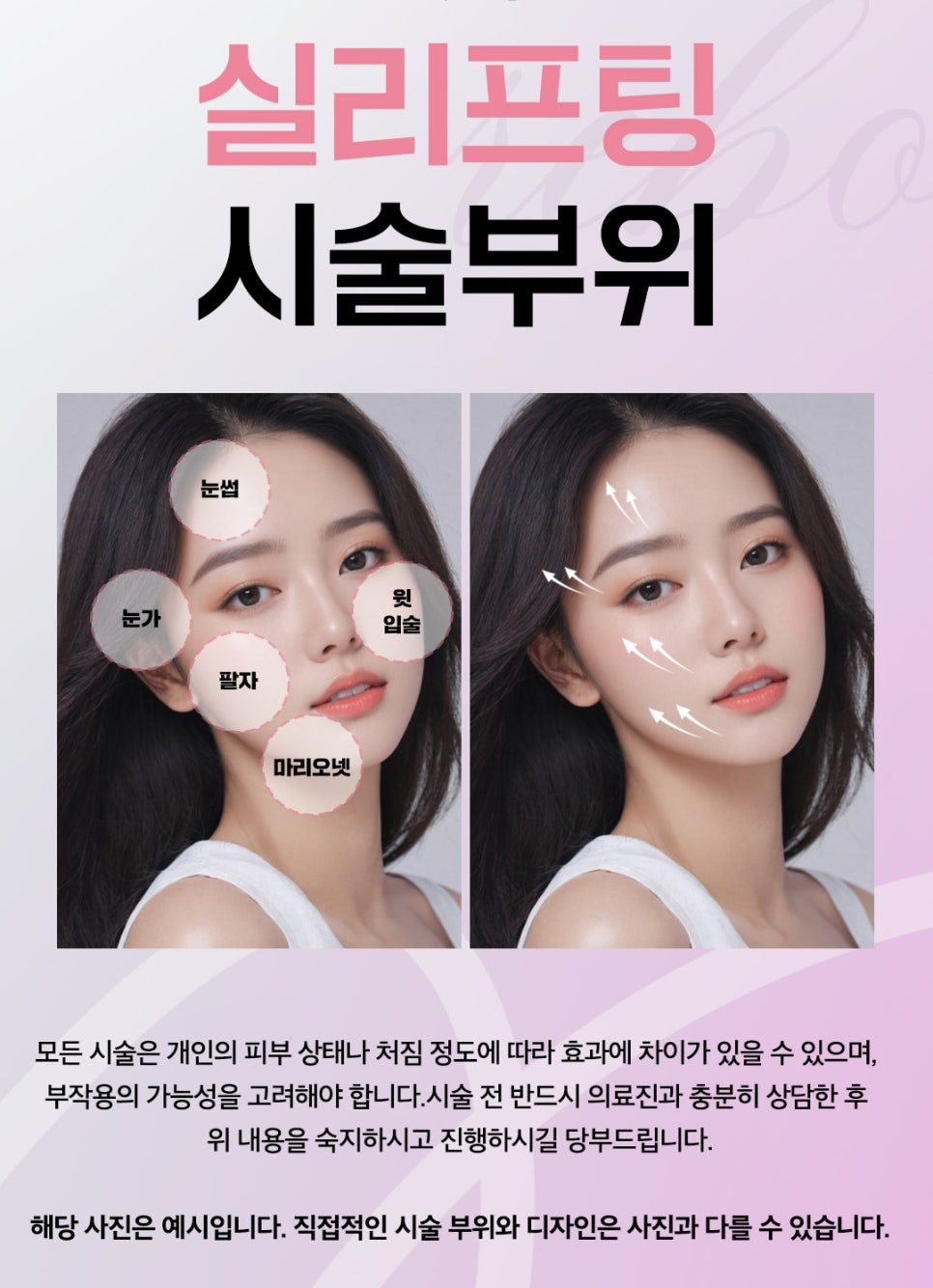처진 얼굴리프팅 팔자주름 불독살 마리오넷 주름을 개선하기 위해서는? (실리프팅) 관련 이미지 1