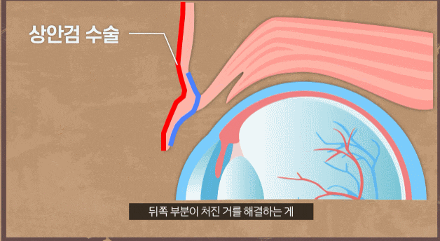 비절개눈매교정 전후 사진만 보고 결정하지 마세요 관련 이미지 4