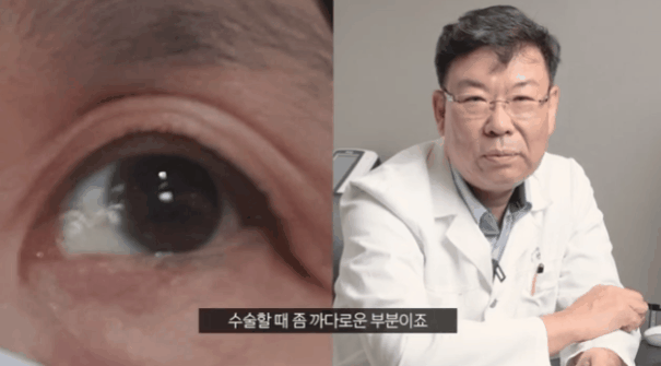 You Should Not Decide on Lower Eyelid Surgery Based on Before-and-After Photos and Reviews! image 1