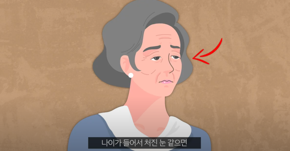 압구정 눈매교정가격 20대~70대 까지 관련 이미지 5