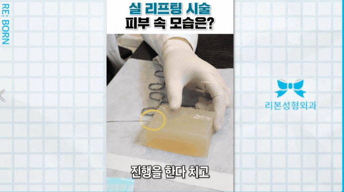 얼굴중안부리프팅 신중하게 결정해야 하는 이유 관련 이미지 4