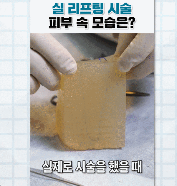 What Is Needed to Create a Sharp V-Line with Bulldog Cheek Thread Lifting? image 3