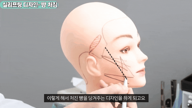신사역 실리프팅 잘하는곳 광대부각, 딤플현상 등 걱정된다면 관련 이미지 2