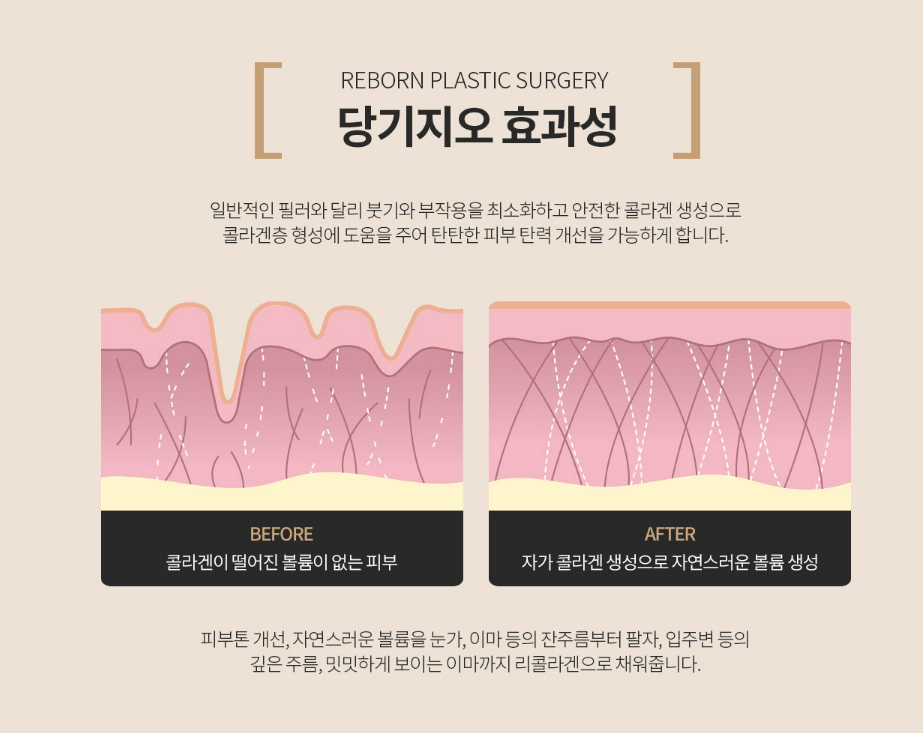 다크서클주사 리콜라겐으로 환하게! 관련 이미지 3