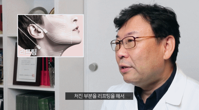 안면거상술 회복기간 너무 부담 갖지 마세요. 관련 이미지 3
