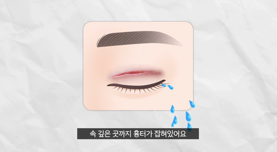 Must-Read If You're Worried That Non-Incision Eye Correction May Come Undone! image 5