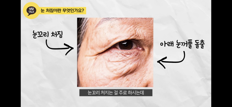 눈꺼풀처짐에 눈꺼풀실리프팅? 중년눈성형? 후기도 확인하자 관련 이미지 8