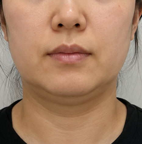 턱선 리프팅 늘어진 턱라인 시술 받을 때 중요한 점은? 관련 이미지 1