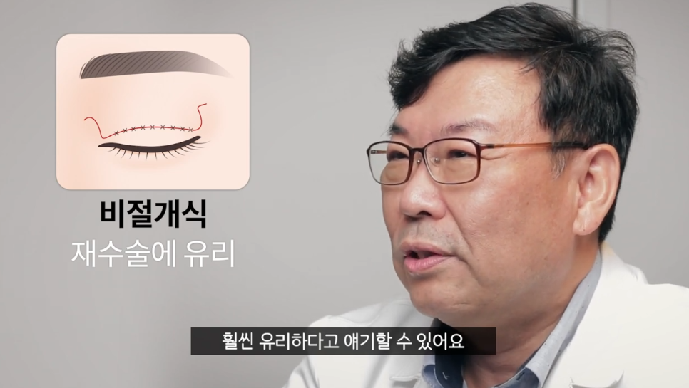Must-Read If You're Worried That Non-Incision Eye Correction May Come Undone! image 2