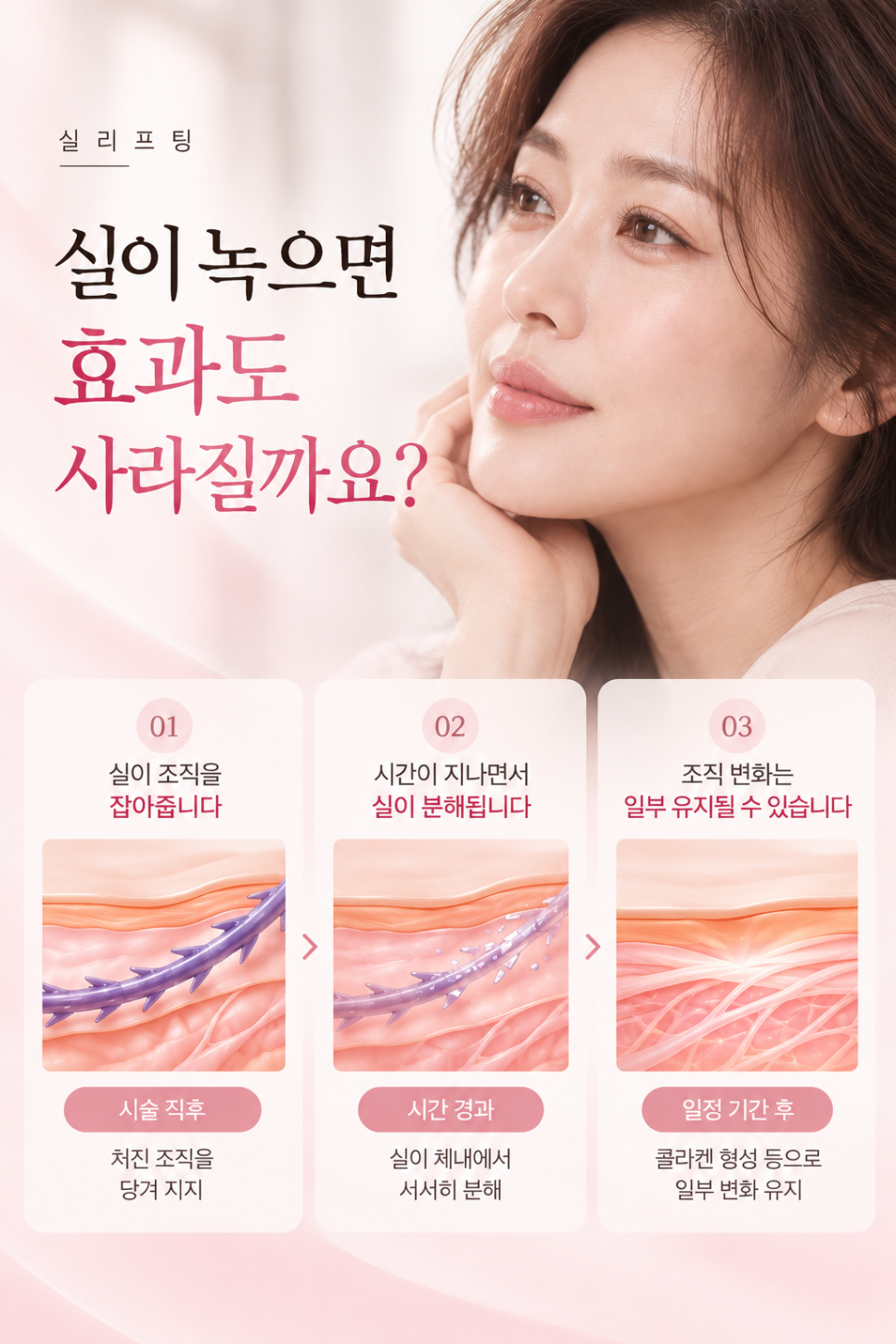 신사동 실리프팅 PDO·PLLA·PCL, 실의 종류에 따라 무엇이 다를까? 관련 이미지 3