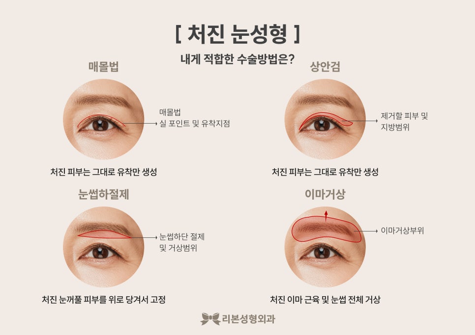 처진눈 수술 비용, 가격 함께 고려해야 할 부분들은? 관련 이미지 2