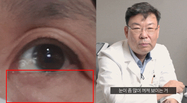Gangnam Saseong? Upper and Lower Eyelid Surgery: Be Sure to Check the Points That Need Attention. image 4
