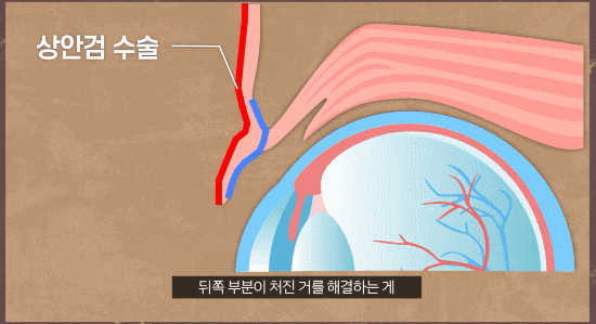 중년상안검/하안검성형  부자연스러울까 봐 걱정된다면 체크하세요. 관련 이미지 3