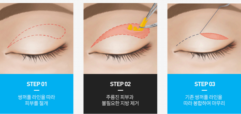 상안검수술 유명한 성형외과 찾는 분들에게 조언해 드립니다. 관련 이미지 3