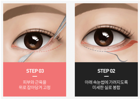 상안검하안검수술 부작용 걱정된다면 이 글을 필독해주세요 관련 이미지 6