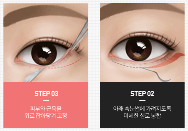 신사역 하안검수술 잘하는곳, 이 글로 쉽게 정리하세요. 관련 이미지 6