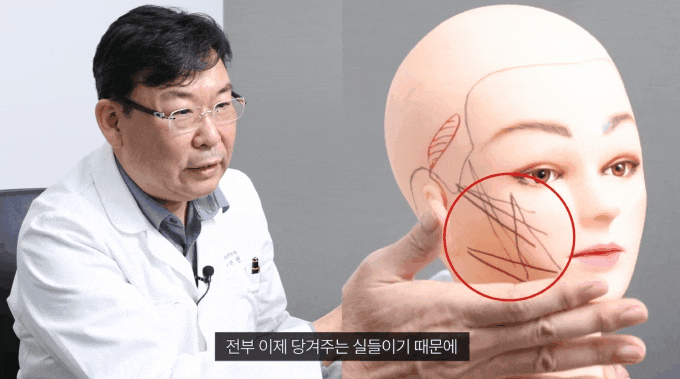 실리프팅 후 광대커짐 부각되는 원인, 광대부각 걱정된다면 관련 이미지 1