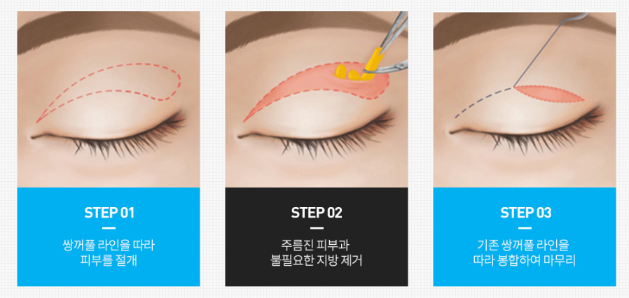 신사동눈성형 상안검하안검 수술 받기 전 필독해주세요. 관련 이미지 3