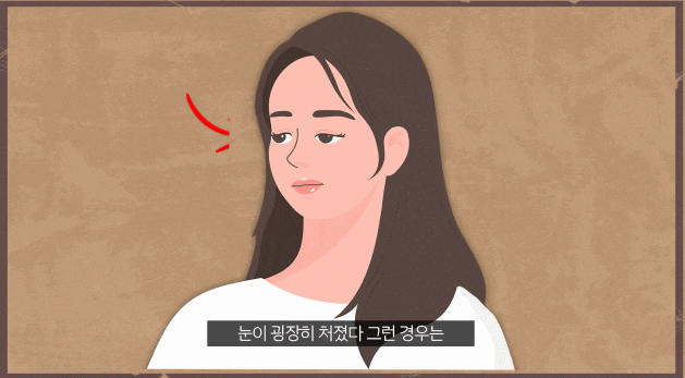 안검하수 눈매교정 수술 전후 사진 찾는 분들에게... 관련 이미지 3