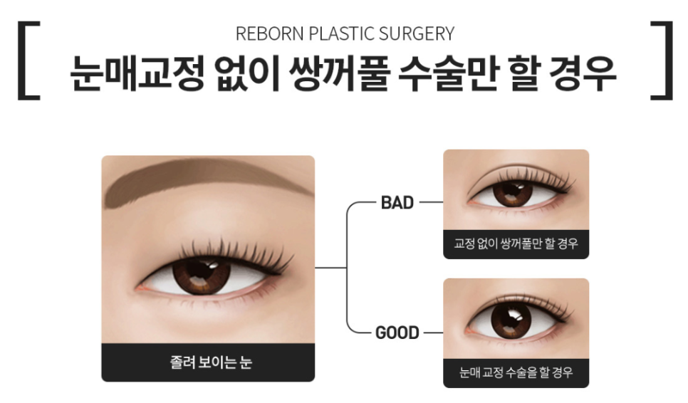 눈매교정수술 전후사진 찾는 분들은 꼭 보세요 관련 이미지 4