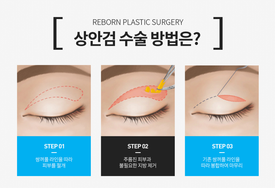 Apgujeong Middle-Aged Eye Surgery: Refined and Elegant image 6