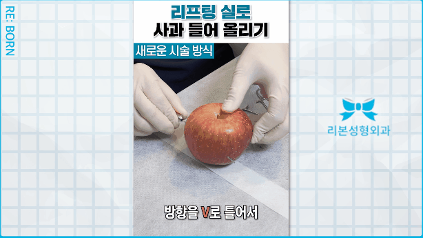 중안면 거상술 붓기 회복기간 걱정된다면 관련 이미지 3