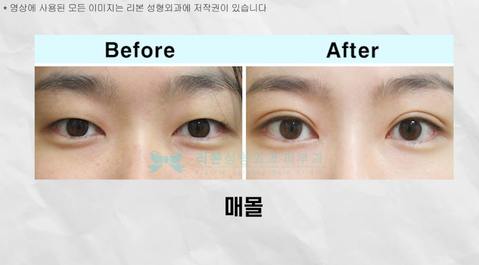 Must-Read If You're Worried That Non-Incision Eye Correction May Come Undone! image 9