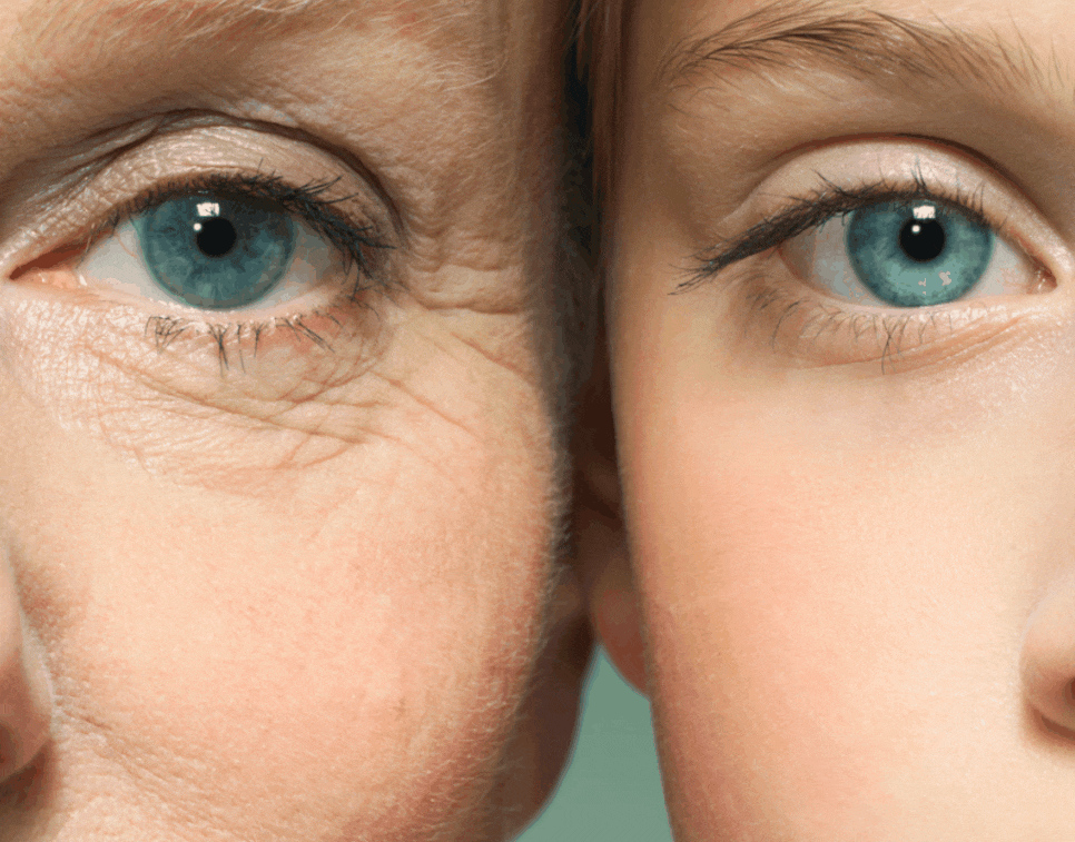 Can fat grafting help when hollow eyelids make you look older? image 3