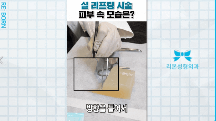 얼굴중안부리프팅 신중하게 결정해야 하는 이유 관련 이미지 2