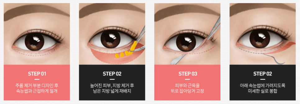 Middle-aged Eye Surgery Review, for Those Looking for Places with Many Before-and-After Photos! image 3