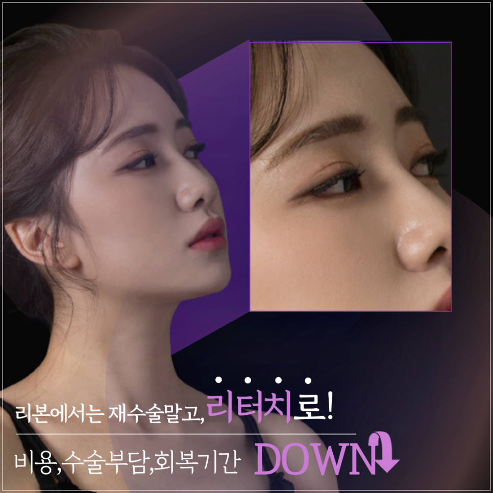 쌍꺼풀수술후 만족이 안된다면 어떻게 해야할까? 관련 이미지 3