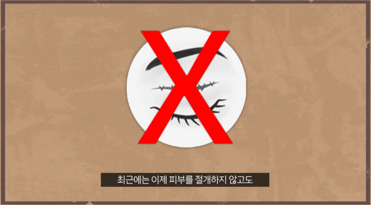 눈매교정수술 전후사진 찾는 분들은 꼭 보세요 관련 이미지 2