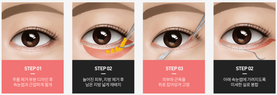 신논현성형외과? 상안검, 하안검 관련 이미지 4