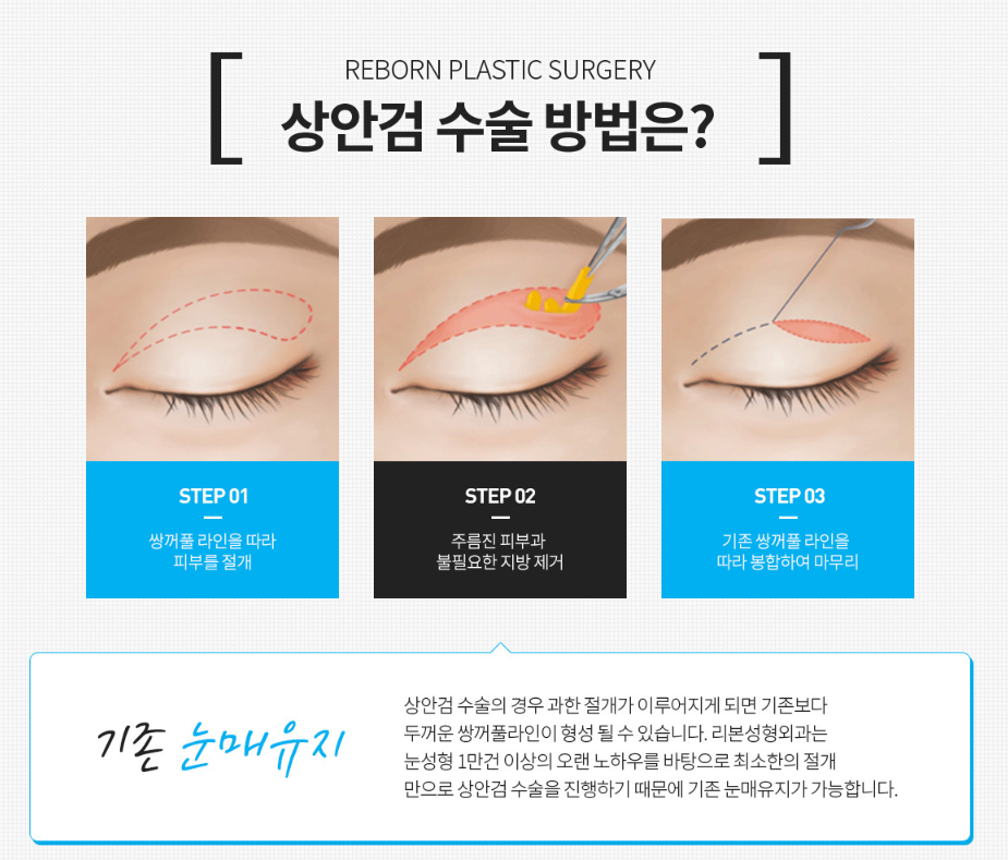 상안검수술 가격, 비용 궁금하다면? 관련 이미지 3
