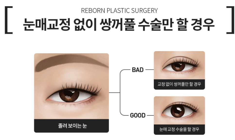 안검하수 눈매교정 수술 전후 사진 찾는 분들에게... 관련 이미지 4