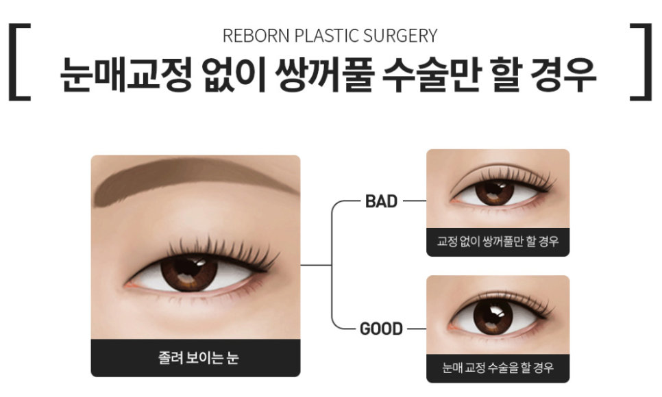 If Your Eyes Look Tired and You Want Surgery for Uneven Eyes, Consider Ptosis Correction image 4