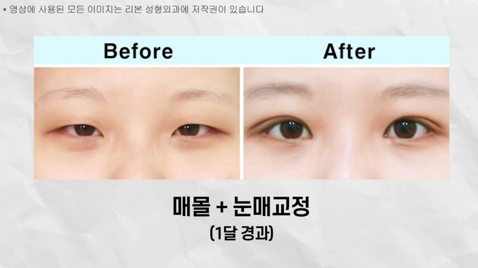 Must-Read If You're Worried That Non-Incision Eye Correction May Come Undone! image 8
