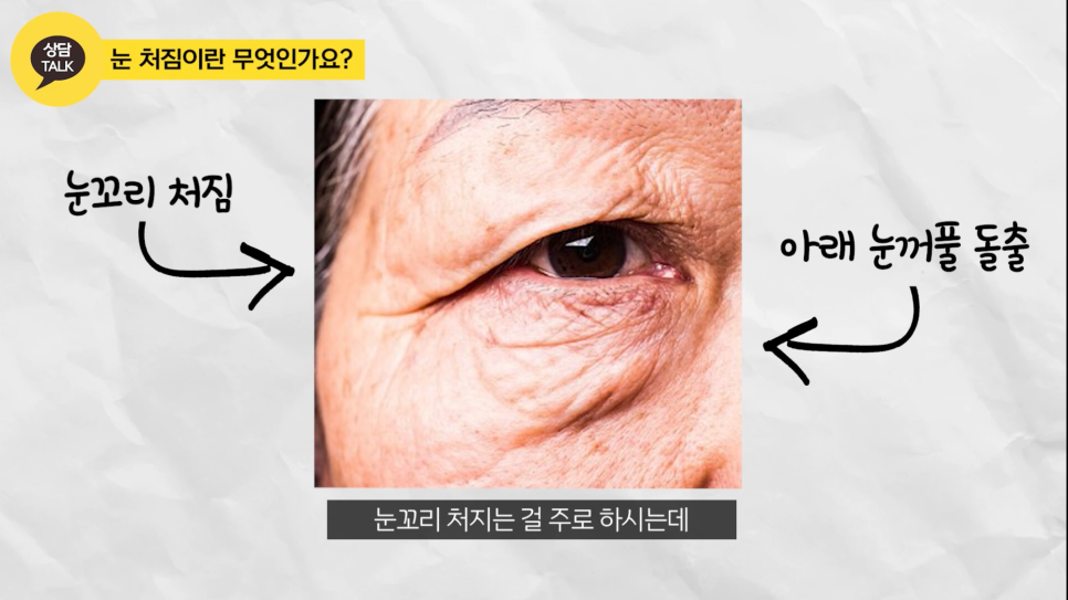 상안검 하안검 수술 후기 원장님 해결책을! 관련 이미지 2