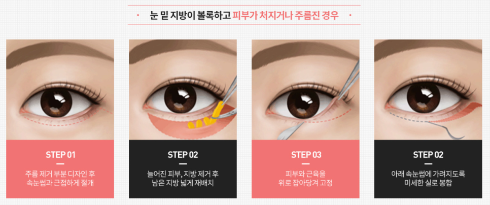 상안검하안검수술 전후 사진보다 이것 확인하세요 관련 이미지 5