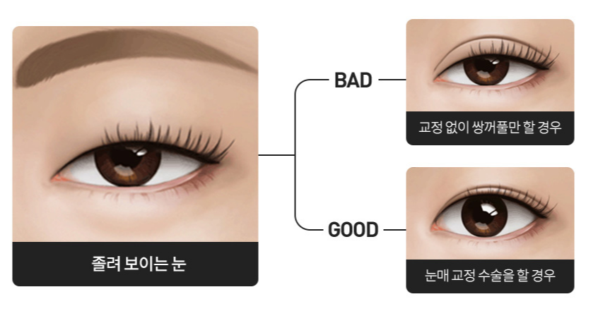 Things to Keep in Mind Before Getting Incisional or Non-incisional Ptosis Correction in Sinsa-dong. image 2