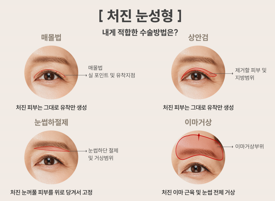 What Are the Types and Effects of Midlife Eye Surgery: Upper Blepharoplasty, Subbrow Lift, and Forehead Lift? image 1