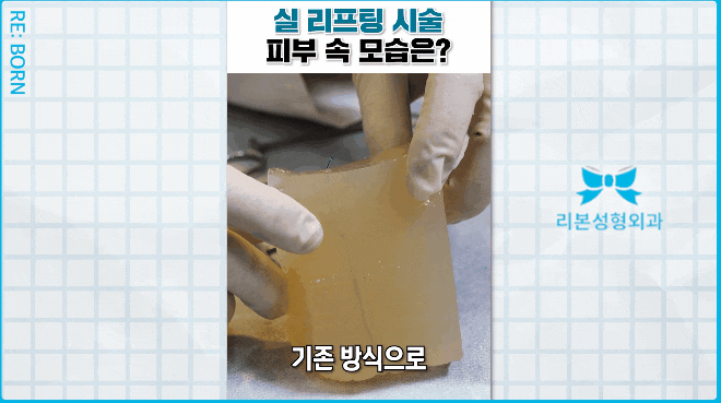 Why Is 1:1 Consultation Important for Marionette Wrinkle Treatment? image 4