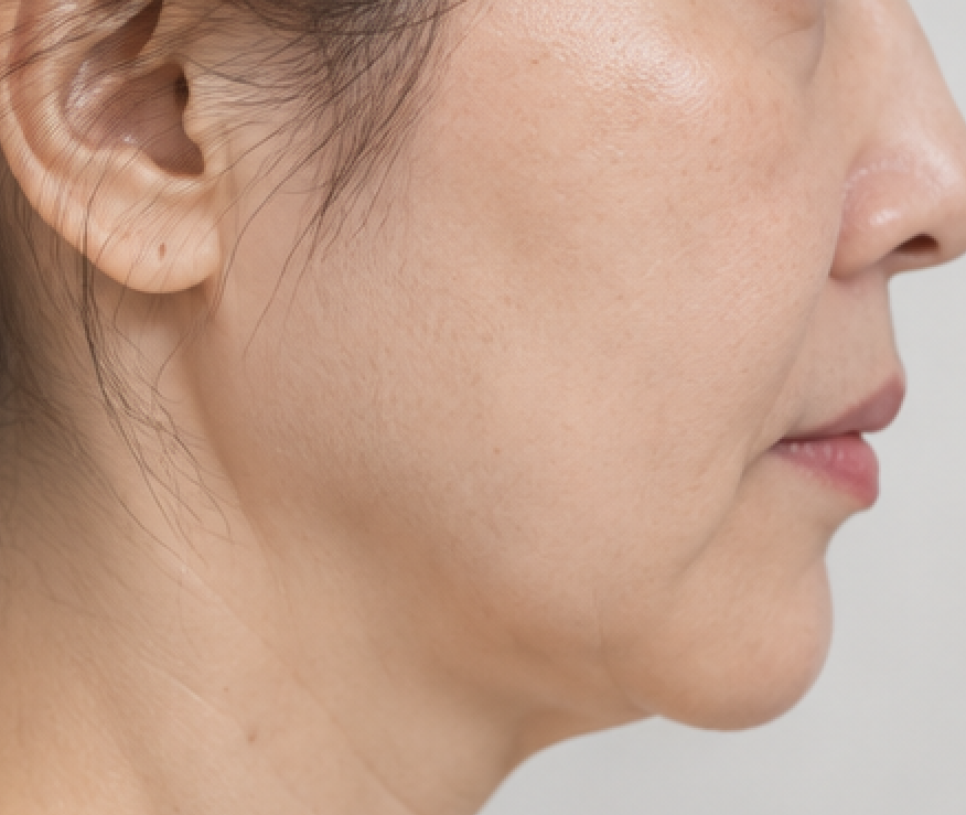 실리프팅 후 붓기 줄이는 방법이 있을까? 회복기간 걱정된다면? 관련 이미지 3