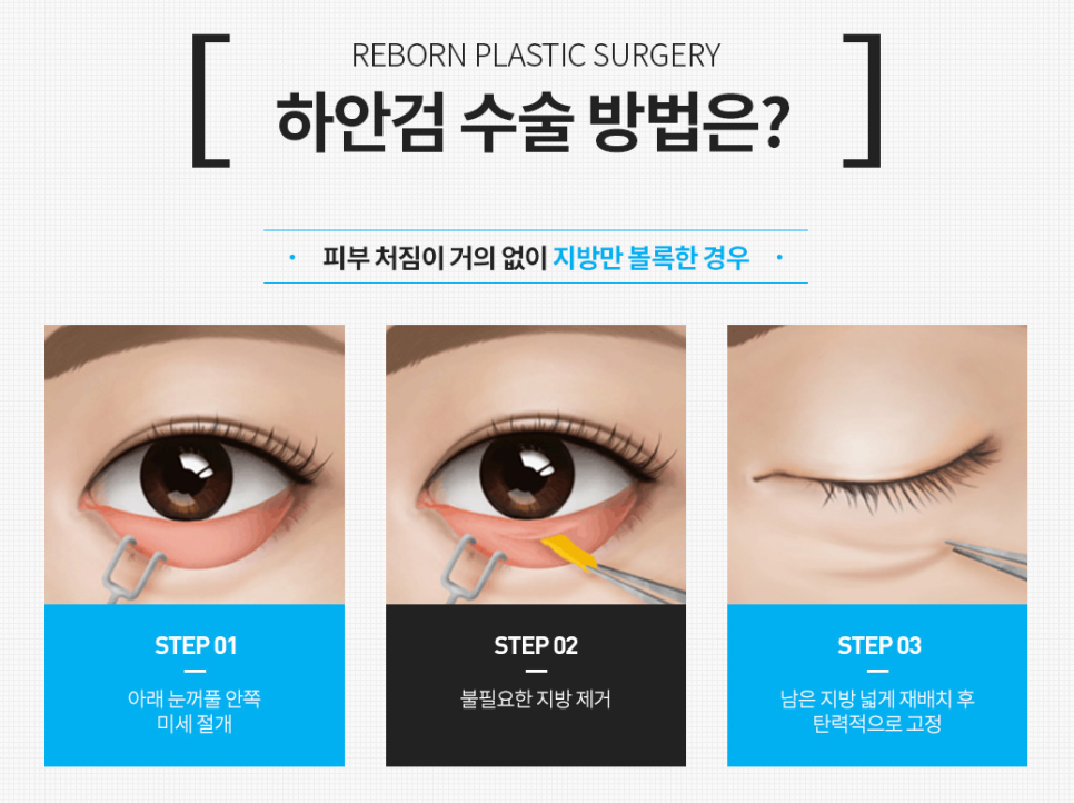 Apgujeong Middle-Aged Eye Surgery: Refined and Elegant image 8